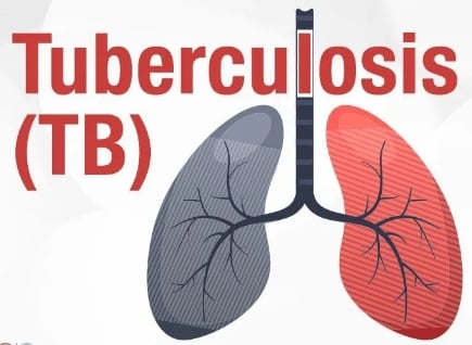 According to the annual India TB report, India has witnessed a 16% decline in tuberculosis (TB) incidence from 2015 to 2022.

